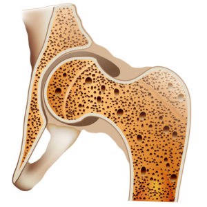 Osteoporose
